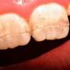 Teeth can be damaged by celiac disease. (Canadian Dental Association)
