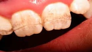 Teeth can be damaged by celiac disease. (Canadian Dental Association)