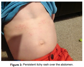 Early Dermatological Manifestation of Childhood Coeliac Disease 2