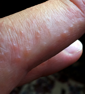 Dermatitis Herpetiformis wp