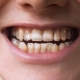 teeth celiac disease wp