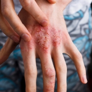 eczema_atopic_dermatitis-celiac-disease