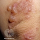 celiac disease dermatitis herpetiformis